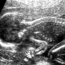 Ultrasound of Fetal Spine Development 